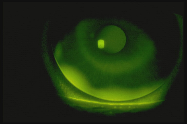 Soft Contact Lenses Bausch + Lomb